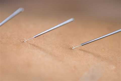 THE BENEFITS OF ACUPUNCTURE FOR CHRONIC PAIN IN THE ELDERLY